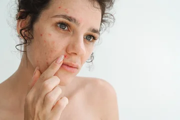 portrait of a young teenage girl with pimples and acne on problematic facial skin. Face of adult woman with bad red inflamed skin and acne in close-up on a white isolated background © alexkoral