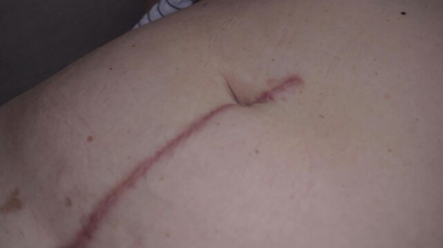 Close-up of a healing surgical incision on a woman's abdomen.