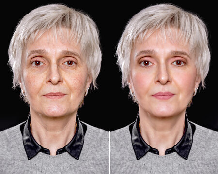 Cosmetic skin rejuvenation procedures for couperose and skin laxity, before and after