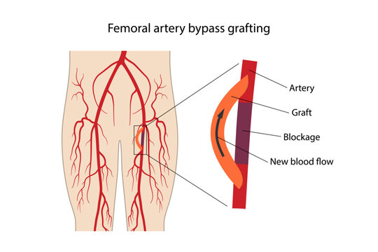 Femoral artery bypass grafting. Medical illustration of the lower extremities and femoral artery bypass grafting diagram. Vector flat style illustration on a white background.