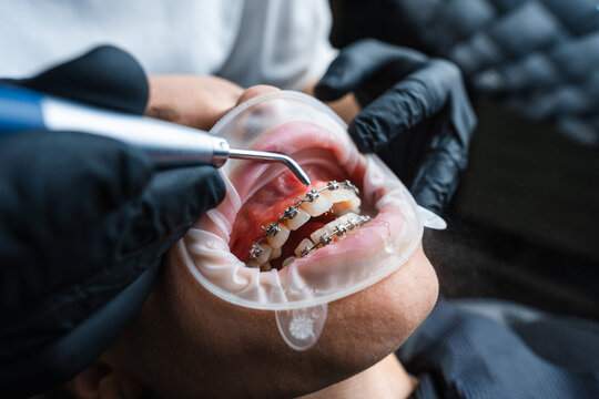 Sterile Dental Environment With Hygienist Meticulously Cleaning Around Brackets Using Ultrasonic Tools