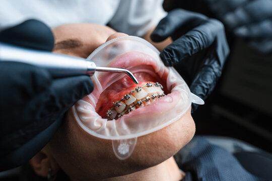 Closeup Dental Cleaning With Ultrasonic Scaler, Dental Hygienist Removing Plaque Around Braces While Suction
