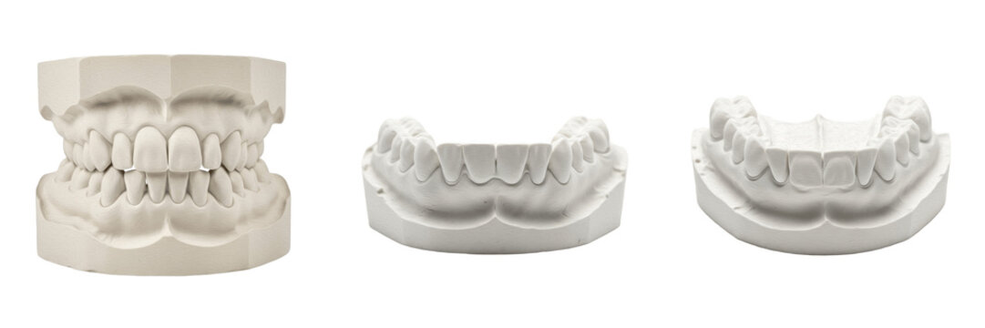 Dental plaster mold of teeth isolated on white background, gypsum dental cast model close up showing full dentition impression, orthodontic study model for bite analysis and treatment planning