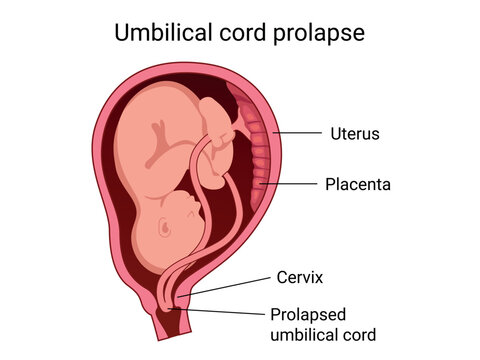 Prolapsed umbilical cord during childbirth. Obstetric complication in which the umbilical cord fall below the presenting part of the fetus. Medical vector illustration
