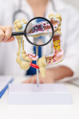 Doctor with human Colon anatomy model. Colonic disease, Large Intestine, Colorectal cancer, Ulcerative colitis, Diverticulitis, Irritable bowel syndrome, Digestive system and Healthcare concept