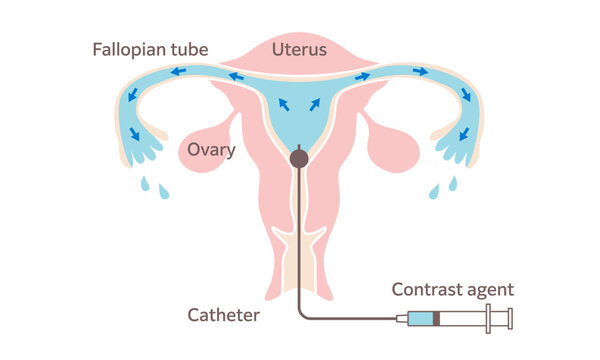 Hysterosalpingography Medical Illustration