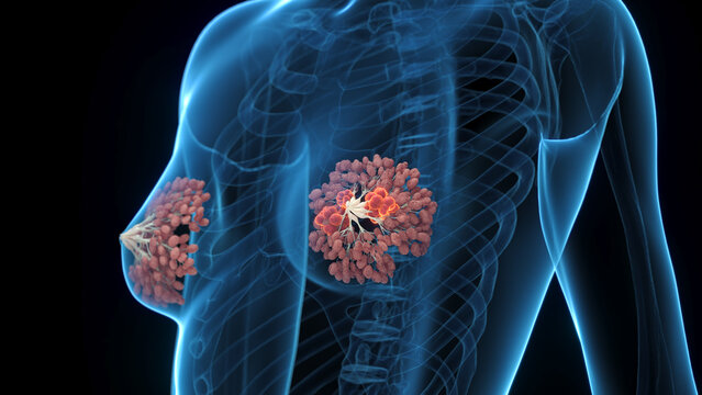 Detailed 3D Render Of Breast Cancer In A Human Female Shown In Full Anatomical View