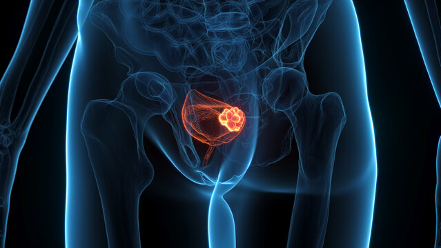 A Detailed 3D Depiction Of Bladder Cancer In A Woman