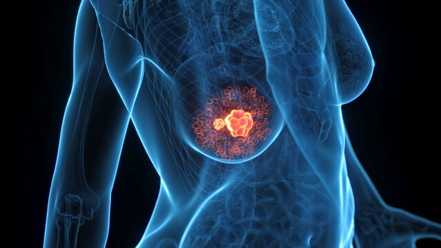 3D Structural Depiction Of Breast Cancer In A Human Female