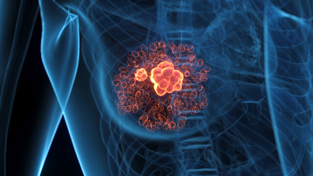 Detailed 3D Render Of Breast Cancer In A Human Female Shown
