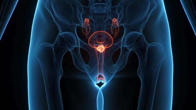 A Detailed 3D Depiction Of Cervical Cancer In A Woman
