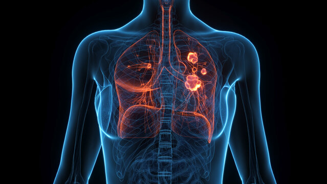A Detailed 3D Depiction Of Lung Cancer In A Human Female