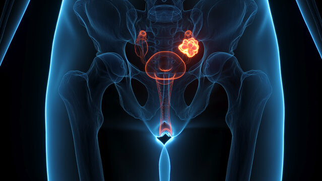 A Detailed 3D Depiction Of Ovarian Cancer In A Woman