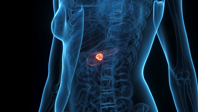 A Detailed 3D Depiction Of Pancreatic Cancer In A Woman