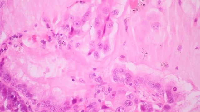 View in microscopic of squamous cell carcinoma, adenonocarcinoma from human cervical cancer, tissue section by H and E stain.Pathology 
