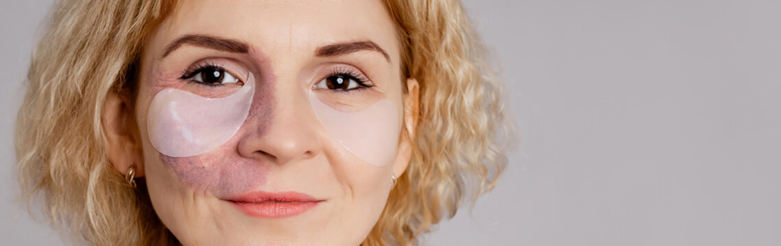 Woman with visible port-wine stain birthmark vascular skin condition wearing  hydrogel under eye patches for skincare beauty routine showing natural diversity authentic representation self-confidence