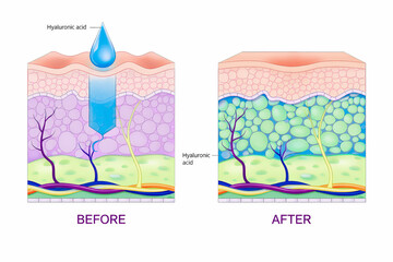Obraz premium Mechanism illustration of hyaluronic acid injection (cross-sectional view of the skin)