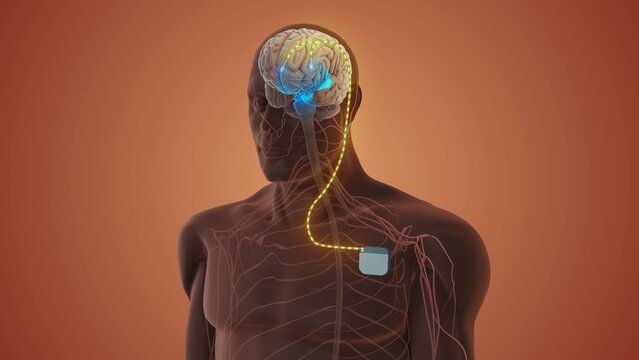 Neurostimulator Implant Regulating Abnormal Brain Signals