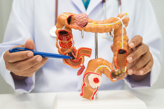 Colorectal cancer, doctor holding intestine colon human model.