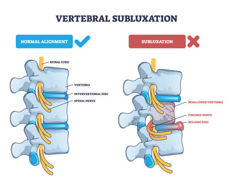 Vertebral subluxation diagram compares normal alignment with misaligned vertebra pinching nerve and bulging disc, key objects, vertebrae, discs, spinal nerves. Outline diagram