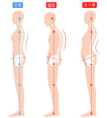 正しい姿勢と猫背と反り腰の女性　背骨と骨盤