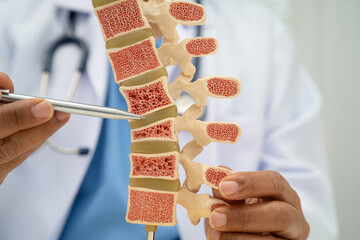 Doctor holding osteoporosis in back bone model for treatment medical in orthopedic department.
