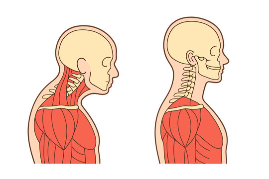 An anatomical illustration comparing poor forward head posture with correct spinal alignment, showing the skull, cervical vertebrae, and upper body muscles in profile view.