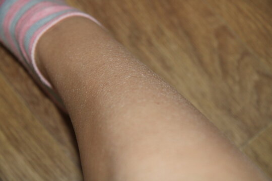 the foot of a man with dry skin,