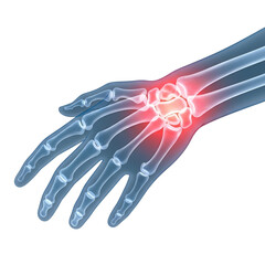Fototapeta premium Illustration of wrist joint with inflamed and pain, medical concept of arthritis and joint injury transparent background