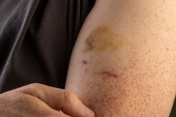 a man's arm with bruises from a blow, the damaged part of a man's arm with red-yellow bruises and healing scratches