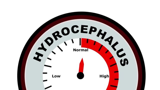Hydrocephalus text or word shown with a barometer or tachometer-style gauge, representing varying levels of severity in the accumulation of cerebrospinal fluid in the brain and its effects on brain