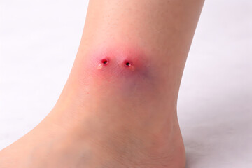 Naklejka premium Photorealistic 3D medical-grade macro close-up of a venomous snakebite puncture marks: two small fang punctures a short distance apart with mild surrounding redness and localized swelling