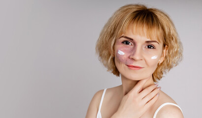 Smiling blonde woman with visible port-wine stain birthmark vascular skin condition applying white facial cream moisturizer skincare treatment on cheeks showing authentic natural beauty diversity