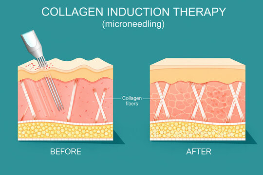 Microneedling procedure. Cross section of a human skin before and after collagen induction therapy. Skin rejuvenation. Anti-aging treatment. Surgical for remove wrinkles, scars, stretch, marks