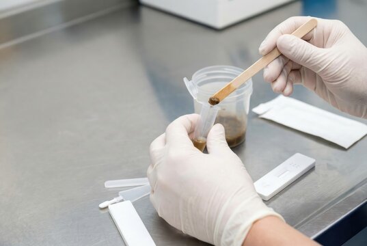 Laboratory technician in gloves preparing a stool sample with a wooden stick for a medical diagnostic test.