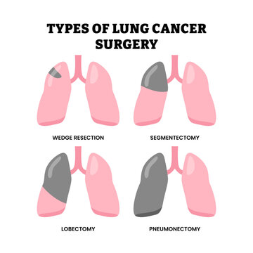 Different types of lung cancer surgery types set collection. Labeled Wedge resection, segmentectomy, lobectomy and pneumonectomy. Lung lobes tumor removal surgery. Medical science illustration.