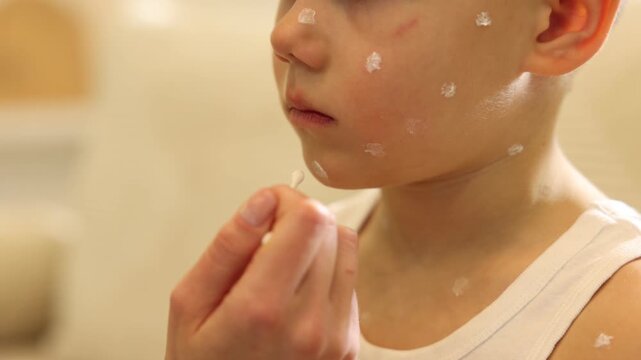 Mother applying cream onto skin of her son with chickenpox at home, closeup