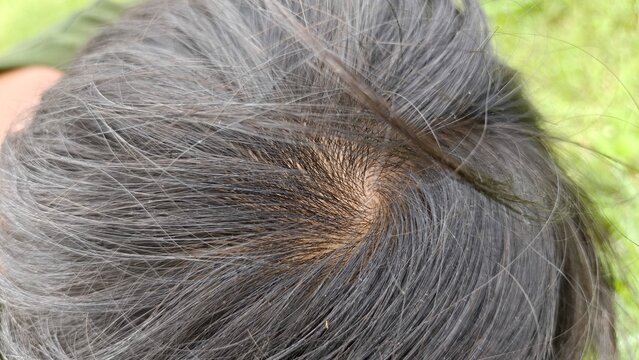Close-up top view of human hair whorl showing natural scalp and black hair texture. Perfect for hair care topics, dermatology, alopecia awareness, genetics, and medical or cosmetic education