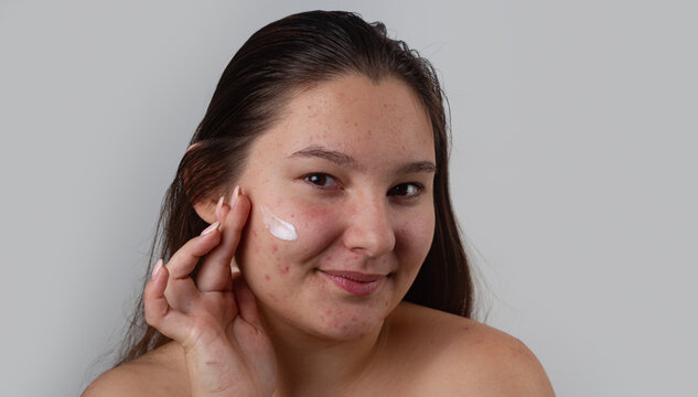 Pimple cream application on cheek. Pimple cream for acne. Pimple skincare cream for skin with acne. Pimple dermatology cream. Facial acne care. Cosmetics for problem skin. Acne treatment.