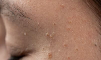 Fototapeta premium Acne on skin with pustule and papules. Closeup of acne with inflamed follicles. Skincare for acne and irritated pores. Macro texture of acne with sebum.