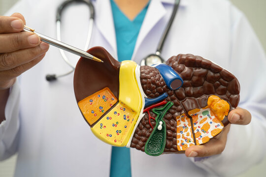 Cirrhosis, Liver cancer, fatty liver, Asian doctor with liver human model.