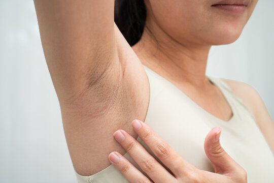 Asian woman have problem black armpit beauty skin care.