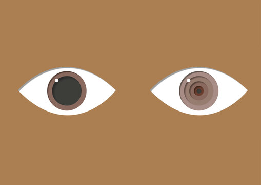 Anisocoria, illustration