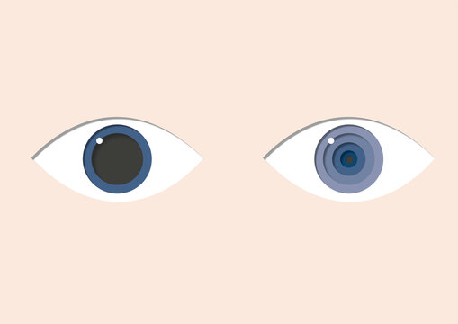 Anisocoria, illustration