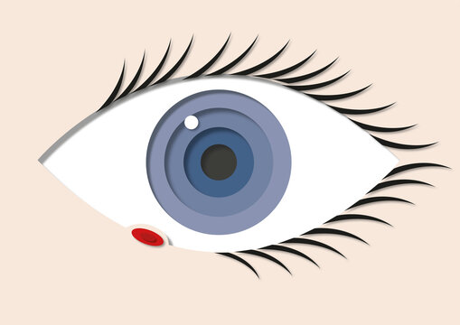Stye, illustration