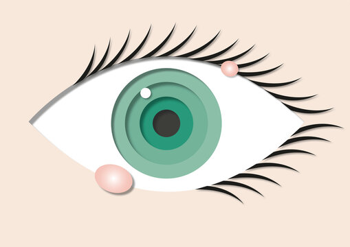 Chalazions, illustration