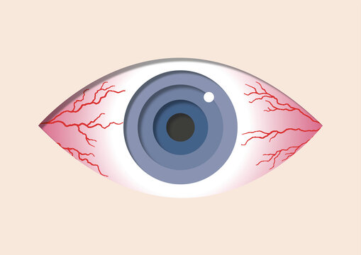 Stinging red eyes, illustration