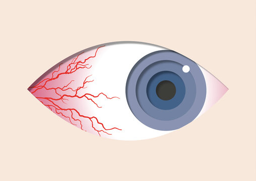 Bloodshot eye, illustration