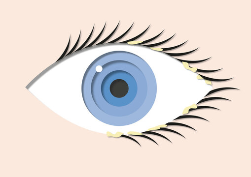 Blepharitis, illustration