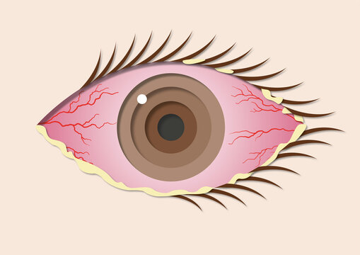 Bacterial conjunctivitis, illustration